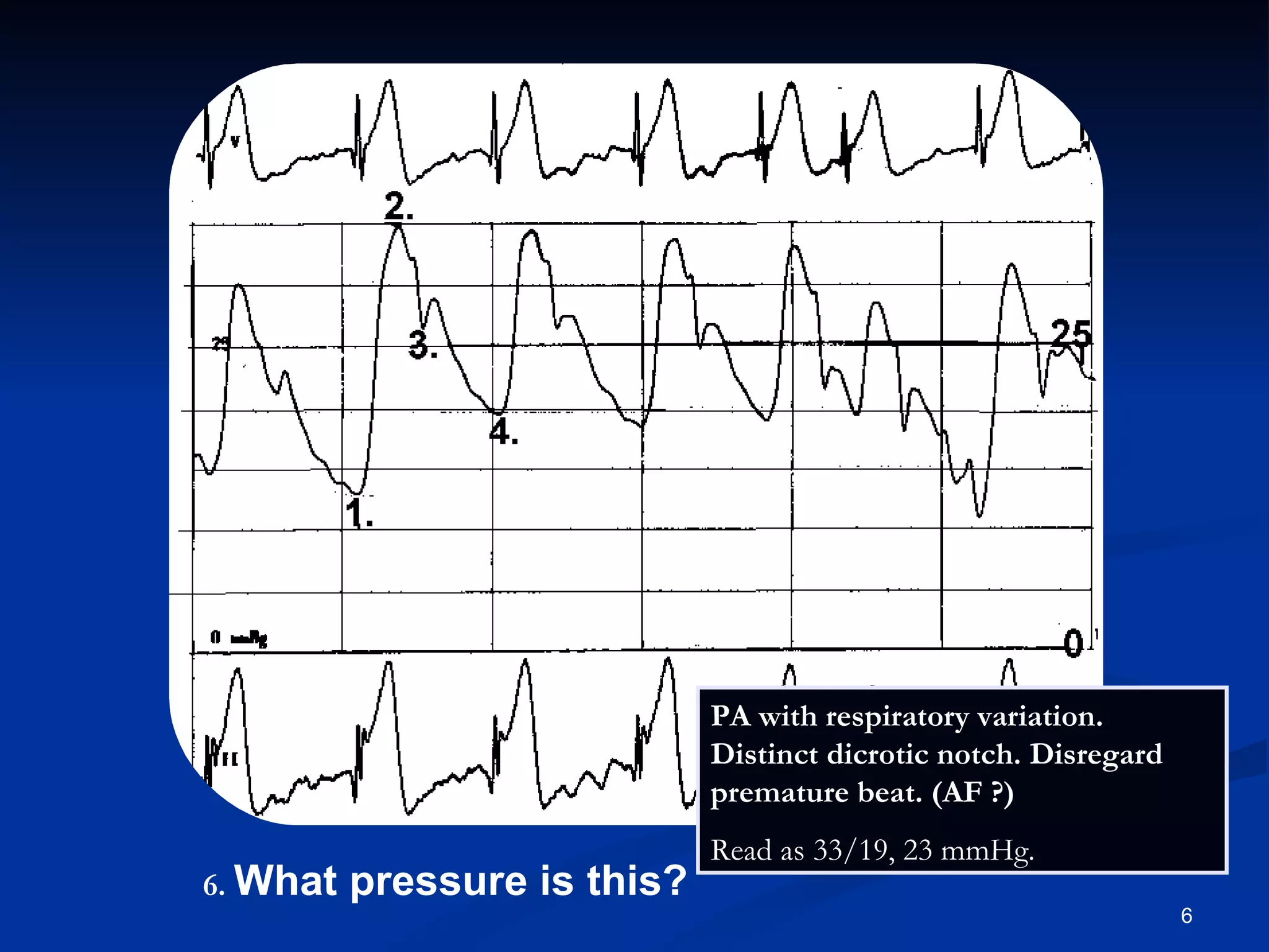 .   What pressure is this? PA with respiratory variation. Distinct dicrotic notch. Disregard premature beat. (AF ?)  Read as 33/19, 23 mmHg. 