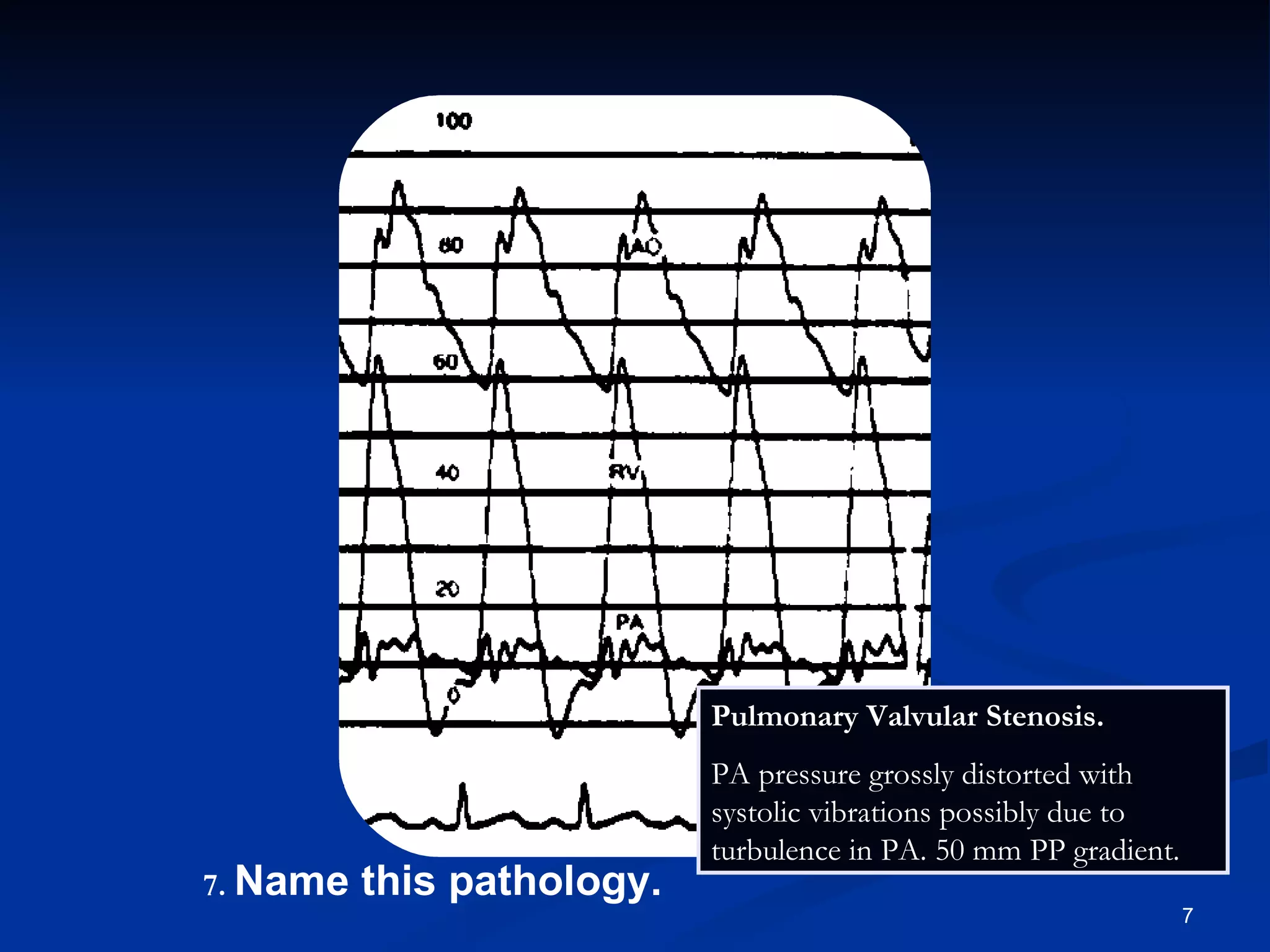 .   Name this pathology. Pulmonary Valvular Stenosis.  PA pressure grossly distorted with systolic vibrations possibly due to turbulence in PA. 50 mm PP gradient. 