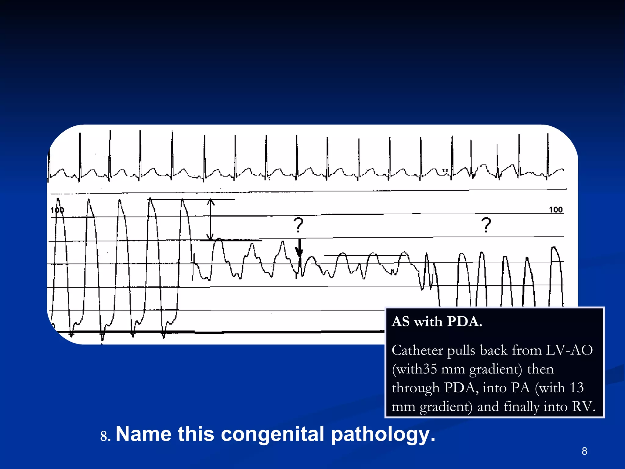 .   Name this congenital pathology. AS with PDA.  Catheter pulls back from LV-AO (with35 mm gradient) then through PDA, into PA (with 13 mm gradient) and finally into RV. 