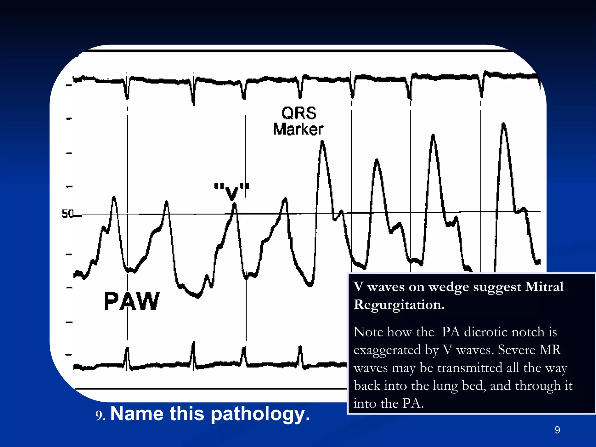 .   Name this pathology. V waves on wedge suggest Mitral Regurgitation.  Note how the  PA dicrotic notch is exaggerated by V waves. Severe MR waves may be transmitted all the way back into the lung bed, and through it into the PA. 