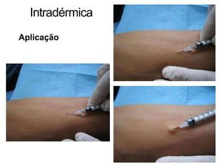 Intradérmica
Aplicação
 