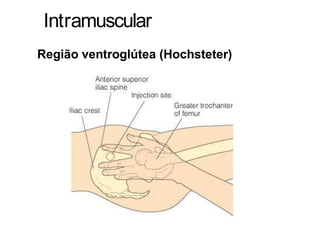 Intramuscular
Região ventroglútea (Hochsteter)
 