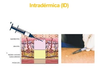 Intradérmica (ID)
 