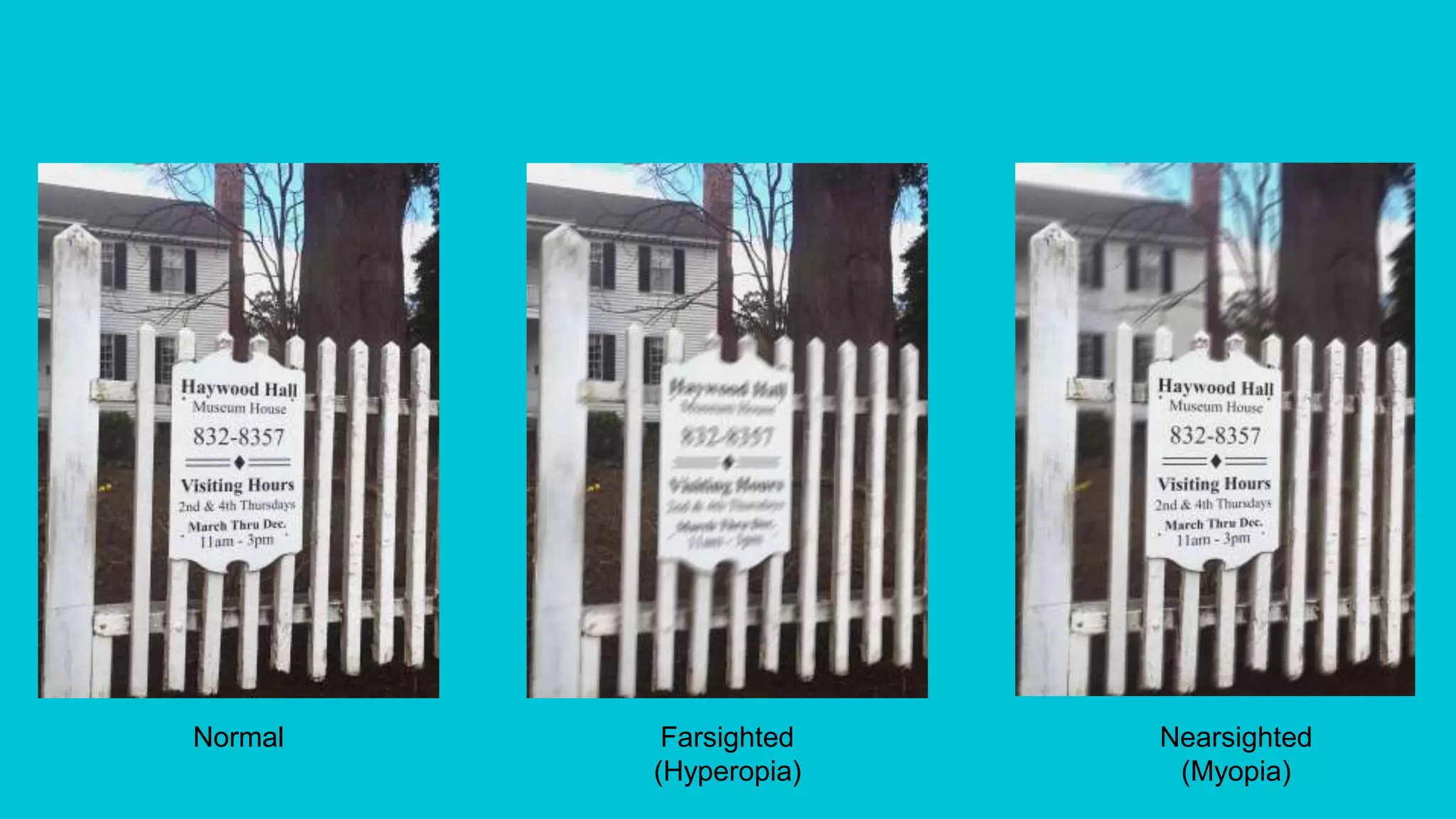 Normal Farsighted
(Hyperopia)
Nearsighted
(Myopia)
 