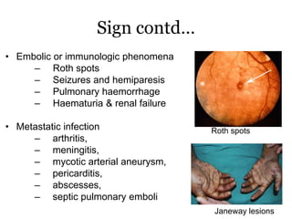 Sign contd…
• Embolic or immunologic phenomena
– Roth spots
– Seizures and hemiparesis
– Pulmonary haemorrhage
– Haematuria & renal failure
• Metastatic infection
– arthritis,
– meningitis,
– mycotic arterial aneurysm,
– pericarditis,
– abscesses,
– septic pulmonary emboli
Roth spots
Janeway lesions
 