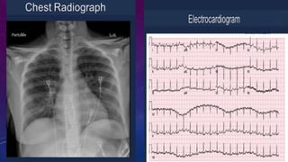 Infective endocarditis 