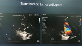 Infective endocarditis 