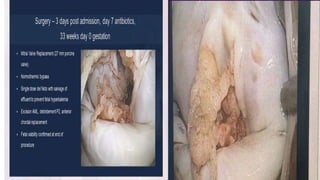 Infective endocarditis 