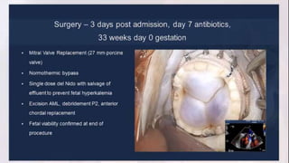 Infective endocarditis 