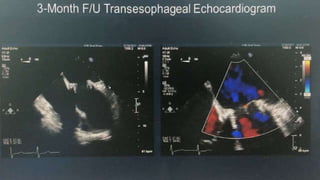 Infective endocarditis 