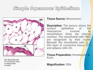 Tissue Source: Mesovarium
Description: The picture shows the
surface epithelium of the
mesovarium covered by
mesothelium (lines the internal
cavities). The mesothelial cells (MC)
are recognized by their nuclei.
Beneath the mesothelial cells is a
thin layer of connective tissue (CT)
and adipose cells (A).
Tissue Preparation: Hematoxylin &
Eosin
Magnification: 350x
MC: Mesothelial cells
CT: Connective Tissue
A: Adipose Cells
N: Nuclei
 