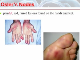 Infective Endocarditis | PPT