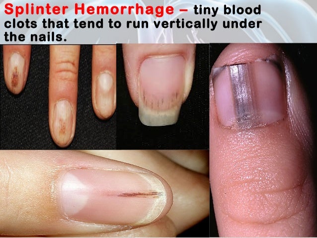 Infective Endocarditis