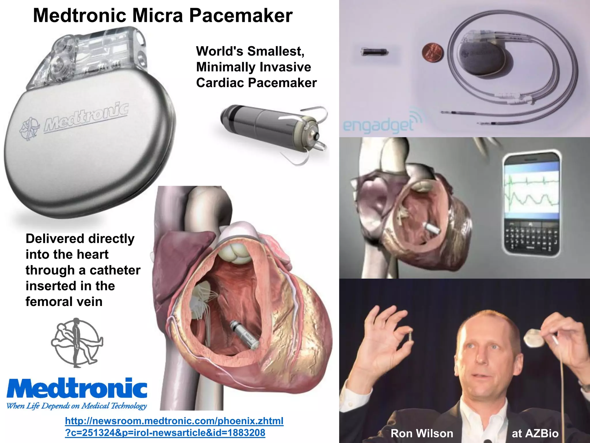 Medtronic Micra Pacemaker
http://newsroom.medtronic.com/phoenix.zhtml
?c=251324&p=irol-newsarticle&id=1883208 Ron Wilson
World's Smallest,
Minimally Invasive
Cardiac Pacemaker
Delivered directly
into the heart
through a catheter
inserted in the
femoral vein
at AZBio
 