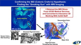 Descending Colon
Sigmoid Colon
Threading Iliac Arteries
Major Kink
Confirming the IBD (Colonic Crohn’s) Hypothesis:
Finding the “Smoking Gun” with MRI Imaging
I Obtained the MRI Slices
From UCSD Medical Services
and Converted to Interactive 3D
Working With Calit2 Staff
Transverse Colon
Liver
Small Intestine
Diseased Sigmoid Colon
Cross Section
MRI Jan 2012
Severe Colon
Wall Swelling
 