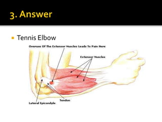  Tennis Elbow
 