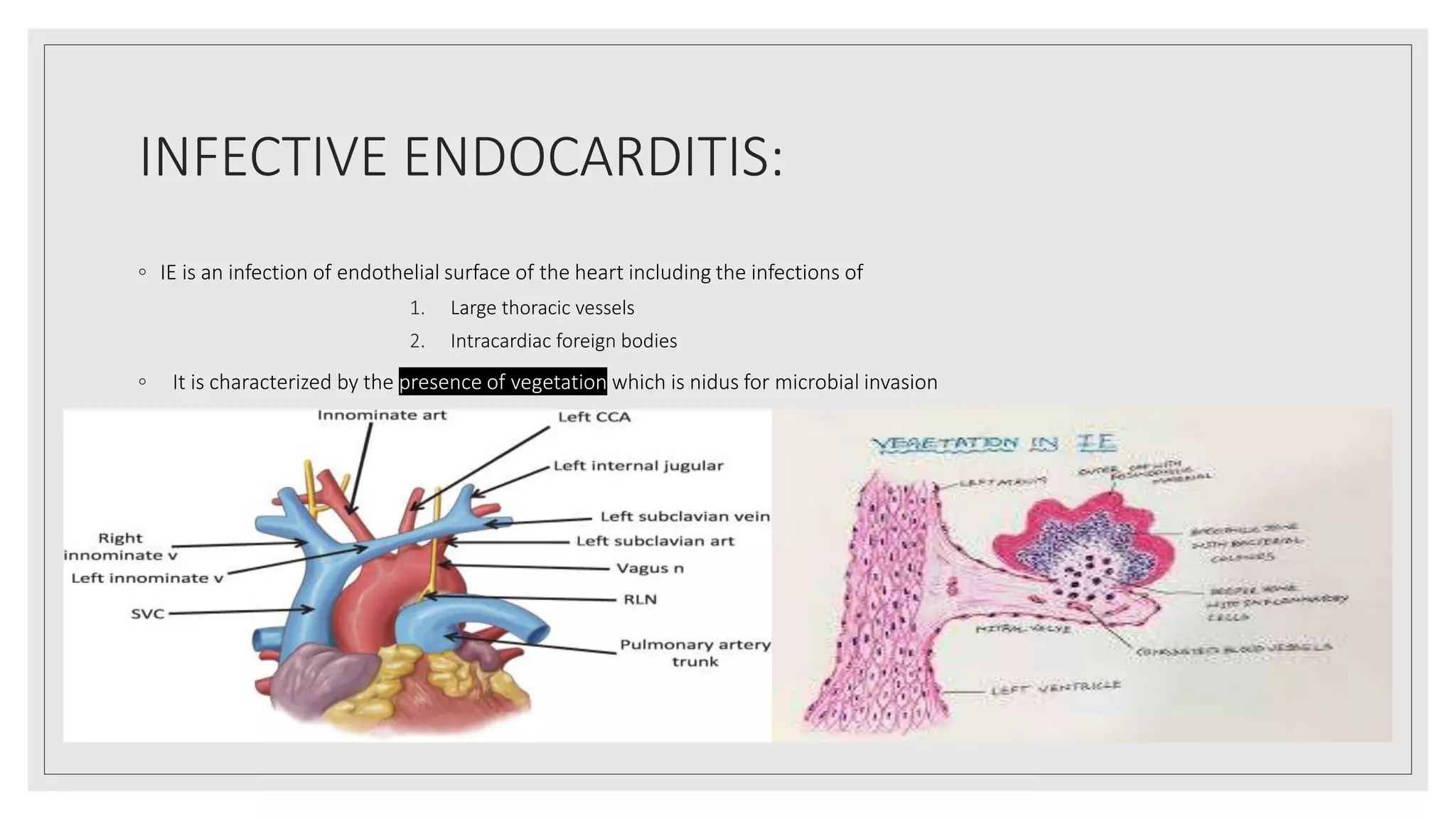 INFECTIVE ENDOCARDITIS:
◦ IE is an infection of endothelial surface of the heart including the infections of
1. Large thoracic vessels
2. Intracardiac foreign bodies
◦ It is characterized by the presence of vegetation which is nidus for microbial invasion
 
