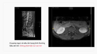 X-quang ngực và siêu âm bụng bình thường
Siêu âm tim: không phát hiện sùi van tim
 
