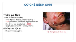 CƠ CHẾ BỆNH SINH
• Thông qua độc tố
‑ Độc tố tế bào (cytotoxin)
‑ TSST-1 (toxic shock syndrome toxin 1) →
TSS (toxic shock syndrome), ngộ độc thức ăn
‑ Độc tố tróc vảy (exfoliative) → SSSS
(staphylococcal scalded-skin syndrome )
• Không qua độc tố
‑ Do chính vi trùng gây ra
Hội chứng tróc vảy do tụ cầu
 