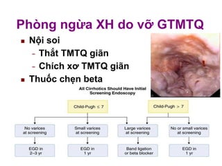 Phòng ngừa XH do vỡ GTMTQ
Nội soi
Thắt TMTQ giãn−
Chích x− ơ TMTQ giãn
 Thuốc chẹn beta
 