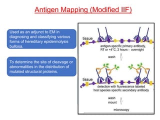 Antigen Mapping (Modified IIF)
Used as an adjunct to EM in
diagnosing and classifying various
forms of hereditary epidermolysis
bullosa.
To determine the site of cleavage or
abnormalities in the distribution of
mutated structural proteins.
 