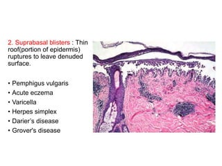 2. Suprabasal blisters : Thin
roof(portion of epidermis)
ruptures to leave denuded
surface.
• Pemphigus vulgaris
• Acute eczema
• Varicella
• Herpes simplex
• Darier’s disease
• Grover's disease
 