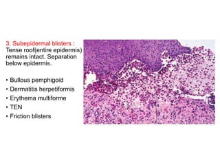 3. Subepidermal blisters :
Tense roof(entire epidermis)
remains intact. Separation
below epidermis.
• Bullous pemphigoid
• Dermatitis herpetiformis
• Erythema multiforme
• TEN
• Friction blisters
 