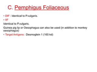 C. Pemphigus Foliaceous
• DIF : Identical to P.vulgaris.
• IIF
Identical to P.vulgaris.
Guinea pig lip or Oesophagus can also be used (in addition to monkey
oesophagus)
• Target Antigens : Desmoglein 1 (160 kd)
 