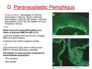 D. Paraneoplastic Pemphigus
• Target Antigens : Desmoglein 3 (130 kd),
Desmoglein 1(160 kd), Plectin (>500 kd),
Desmoplakin I (250 kd), BP antigen I (230 kd),
Desmoplakin II (210 kd), Envoplakin (210 kd),
Periplakin (190 kd)
• DIF :
Weak focal cell surface/ICS pattern and
linear or granular BMZ for IgG or C3.
Lichenoid changes also may be seen (shaggy
BMZ and cytoid bodies).
Increased rate of false-negative results.
• IIF
Cell surface/ICS (IgG) with or without linear
BMZ on monkey esophagus substrate.
Rat bladder is most sensitive substrate for
paraneoplastic pemphigus.
- 75% sensitive
- 83% specific
 