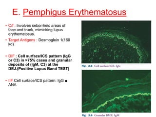 E. Pemphigus Erythematosus
• C/f : Involves seborrheic areas of
face and trunk, mimicking lupus
erythematosus.
• Target Antigens : Desmoglein 1(160
kd)
• DIF : Cell surface/ICS pattern (IgG
or C3) in >75% cases and granular
deposits of (IgM, C3) at the
DEJ.(Positive Lupus Band TEST)
• IIF Cell surface/ICS pattern: IgG ■
ANA
 
