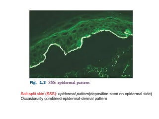Salt-split skin (SSS): epidermal pattern(deposition seen on epidermal side)
Occasionally combined epidermal-dermal pattern
 