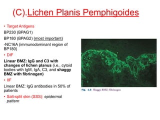 (C).Lichen Planis Pemphigoides
• Target Antigens
BP230 (BPAG1)
BP180 (BPAG2) (most important)
-NC16A (immunodominant region of
BP180)
• DIF
Linear BMZ: IgG and C3 with
changes of lichen planus (i.e., cytoid
bodies with IgM, IgA, C3, and shaggy
BMZ with fibrinogen)
• IIF
Linear BMZ: IgG antibodies in 50% of
patients
• Salt-split skin (SSS): epidermal
pattern
 