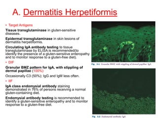 A. Dermatitis Herpetiformis
• Target Antigens
Tissue transglutaminase in gluten-sensitive
diseases.
Epidermal transglutaminase in skin lesions of
dermatitis herpetiformis.
Circulating IgA antibody testing to tissue
transglutaminase by ELISA is recommended(to
identify the presence of a gluten-sensitive enteropathy
and to monitor response to a gluten-free diet).
• DIF
Granular BMZ pattern for IgA, with stippling of
dermal papillae (100%)
Occasionally C3 (50%); IgG and IgM less often.
• IIF
IgA class endomysial antibody staining
demonstrated in 76% of persons receiving a normal
gluten-containing diet.
Endomysial antibody testing is recommended to
identify a gluten-sensitive enteropathy and to monitor
response to a gluten-free diet.
 