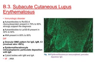 B.3. Subacute Cutaneous Lupus
Erythematosus
• Immunologic disorder
■ Autoantibodies to Ro/SS-A
ribonucleoprotein present in 70% to 90%
strongly support the diagnosis
■ Autoantibodies to La/SS-B present in
30% to 50%
■ ANA present in 60% to 80%
DIF
■ Granular BMZ pattern for IgG, IgM, C3
(involved skin >90%)
■ Epidermal/keratinocyte
intracytoplasmic particulate deposition
with IgG
■ Cytoid bodies with IgM and IgA
• IIF : ANA
 