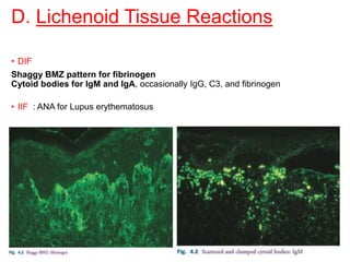 D. Lichenoid Tissue Reactions
• DIF
Shaggy BMZ pattern for fibrinogen
Cytoid bodies for IgM and IgA, occasionally IgG, C3, and fibrinogen
• IIF : ANA for Lupus erythematosus
 