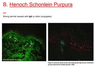B. Henoch Schonlein Purpura
DIF
Strong dermal vessels with IgA (± other conjugates)
 