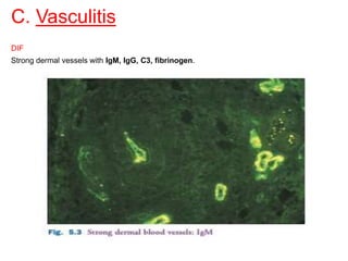 C. Vasculitis
DIF
Strong dermal vessels with IgM, IgG, C3, fibrinogen.
 