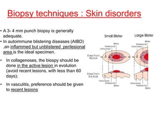 Biopsy techniques : Skin disorders
• A 3- 4 mm punch biopsy is generally
adequate.
• In autoimmune blistering diseases (AIBD)
,an inflammed but unblistered perilesional
area is the ideal specimen.
• In collagenoses, the biospy should be
done in the active lesion in evolution
(avoid recent lesions, with less than 60
days);
• In vasculitis, preference should be given
to recent lesions
 