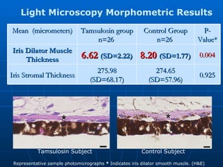 Control Subject Tamsulosin Subject Light Microscopy Morphometric Results  Representative sample photomicrographs  *  Indicates iris dilator smooth muscle. (H&E) Mean  (micrometers) Tamsulosin group n=26  Control Group n=26  P-Value* Iris Dilator Muscle Thickness 6.62  (SD=2.22) 8.20   (SD=1.77) 0.004 Iris Stromal Thickness 275.98 (SD=68.17) 274.65 (SD=57.96) 0.925 
