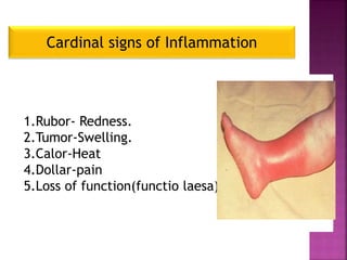 Cardinal signs of Inflammation
1.Rubor- Redness.
2.Tumor-Swelling.
3.Calor-Heat
4.Dollar-pain
5.Loss of function(functio laesa)
 