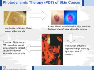 14Ifor Samuel, University of St Andrews
Photodynamic Therapy (PDT) of Skin Cancer
Illumination of tumour
region with high intensity
light source for 20
minutes
Presence of light causes
PP9 to produce singlet
Oxygen leading to local
cellular destruction
within the tumour only
Application of ALA or Metvix
cream at tumour site
ALA or Metvix metabolised to Light sensitive
Protoporphyrin 9 only within the tumour
 