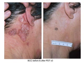 BCC before & after PDT x3
 