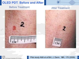 19Ifor Samuel, University of St Andrews
OLED PDT: Before and After
Before Treatment After Treatment
Pilot study Attili et al Brit. J. Derm. 161, 170 (2009)
 