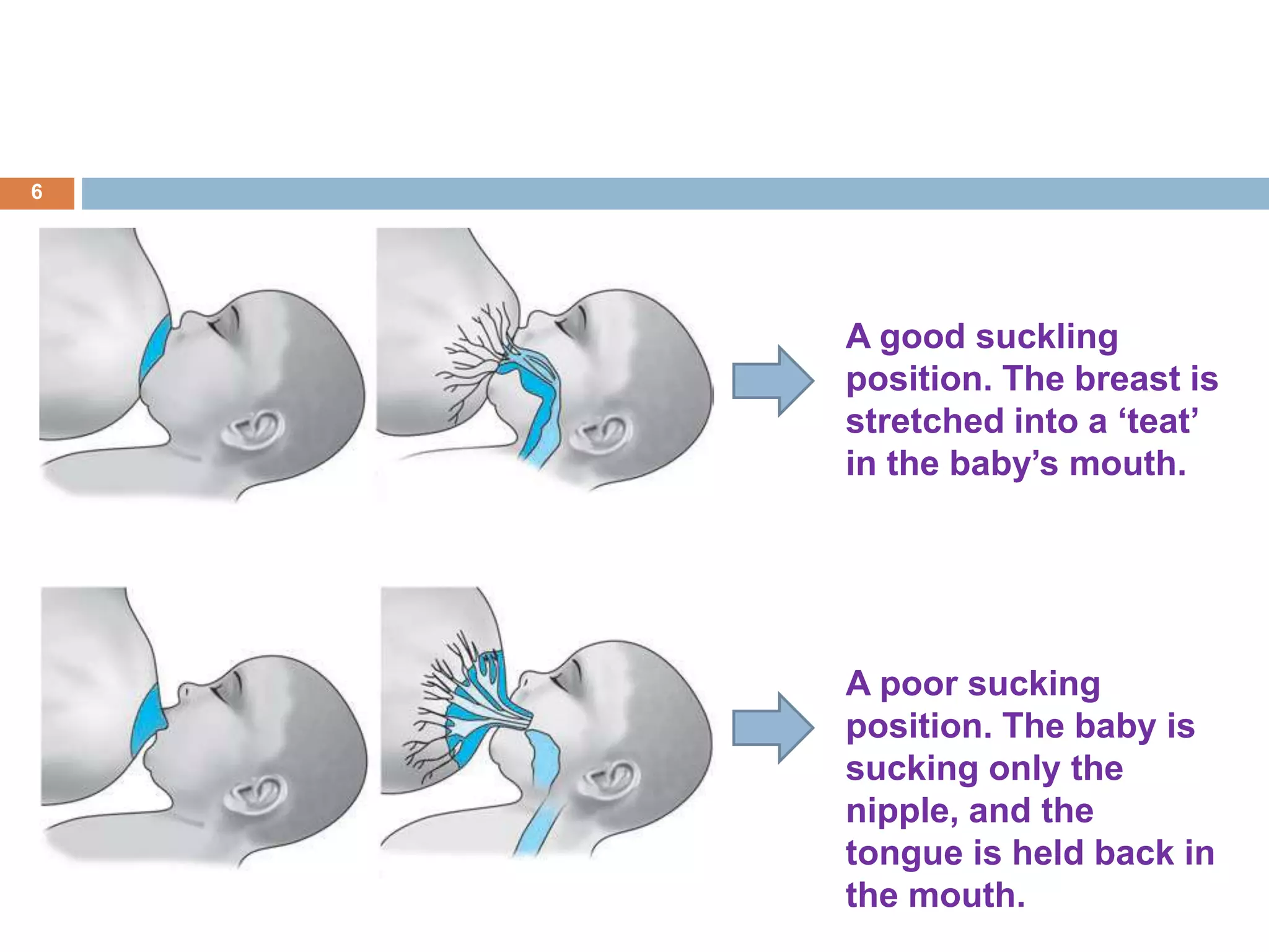 A good suckling
position. The breast is
stretched into a ‘teat’
in the baby’s mouth.
A poor sucking
position. The baby is
sucking only the
nipple, and the
tongue is held back in
the mouth.
6
 