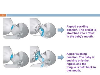 A good suckling
position. The breast is
stretched into a ‘teat’
in the baby’s mouth.
A poor sucking
position. The baby is
sucking only the
nipple, and the
tongue is held back in
the mouth.
6
 