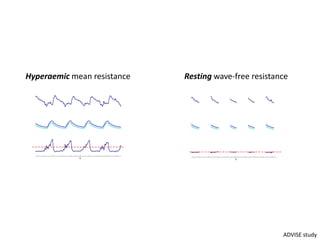 0
0.2
0.4
0
1
2
3
0 5 10
0
750
Velocity
(M-2)
Pressure
(mmHg)
Resistance
(mmHgM
-2
)
Time(s)
0
0.2
0.4
0
1
2
3
0 5 10
0
750
Velocity
(M-2)
Pressure
(mmHg)
Resistance
(mmHgM
-2
)
Time(s)
Hyperaemic mean resistance Resting wave-free resistance
ADVISE study
 