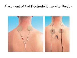 Placement of Pad Electrode for cervical Region
 