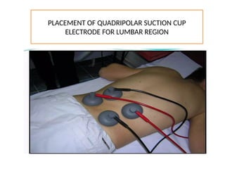 PLACEMENT OF QUADRIPOLAR SUCTION CUP
ELECTRODE FOR LUMBAR REGION
 
