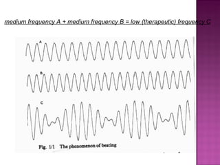 medium frequency A + medium frequency B = low (therapeutic) frequency C
 