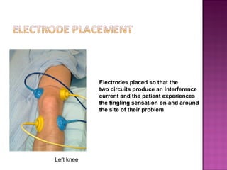 Electrodes placed so that the
            two circuits produce an interference
            current and the patient experiences
            the tingling sensation on and around
            the site of their problem




Left knee
 
